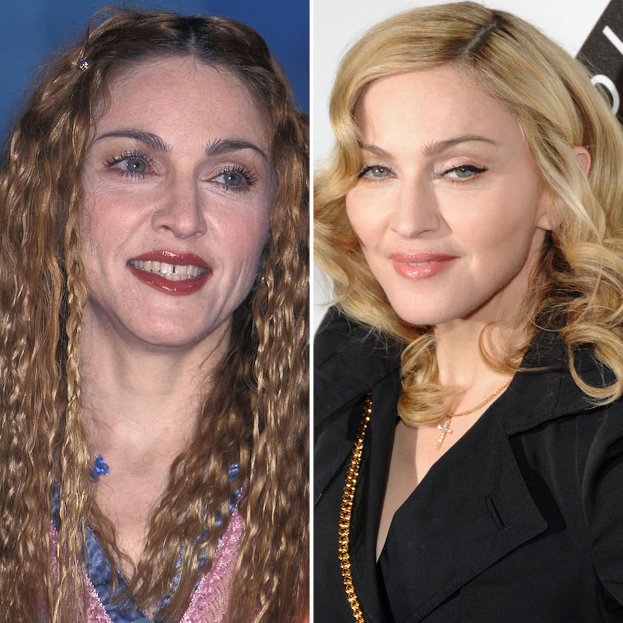 celebrities before and after plastic surgery