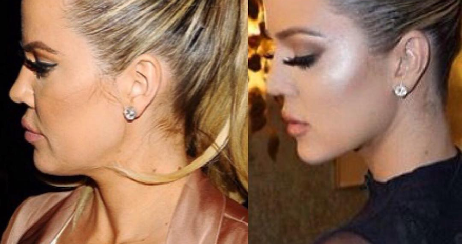 celebrity jawline surgery