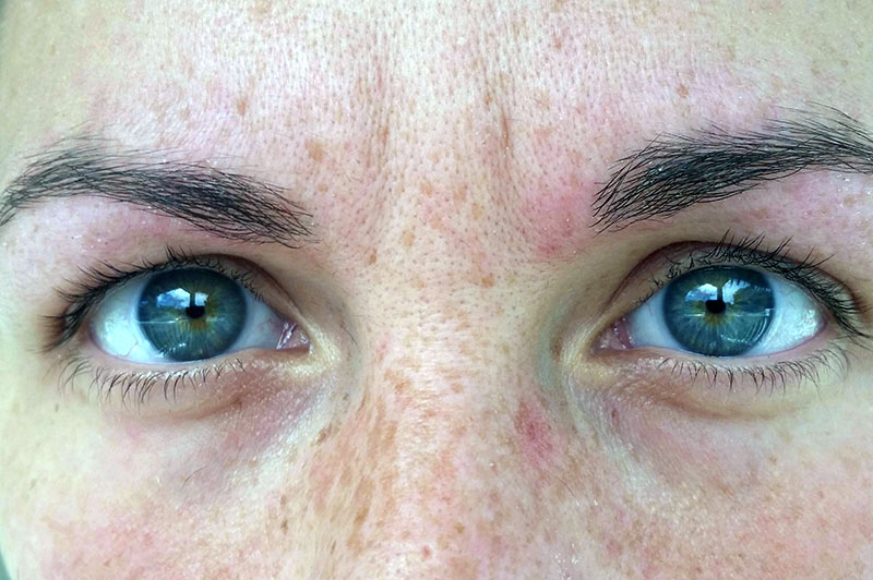 Signs You Need to Get an Eye Lift